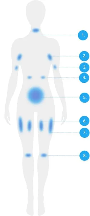 Front body diagram with numbered treatable fat areas for CoolSculpting fat freezing in Dublin